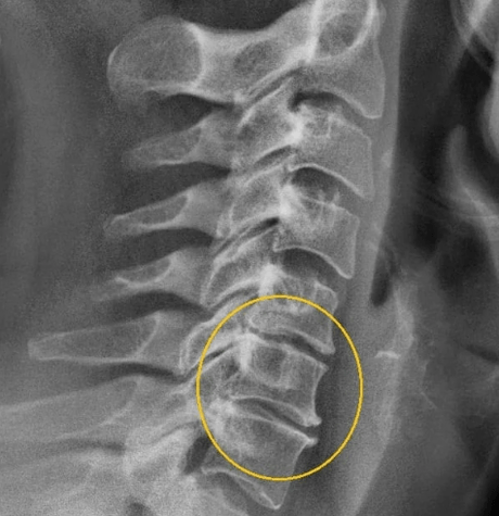 osteocondrosi cervicale